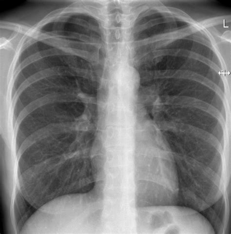 Rentgenový snímek plic dítěte s bronchiolitidou