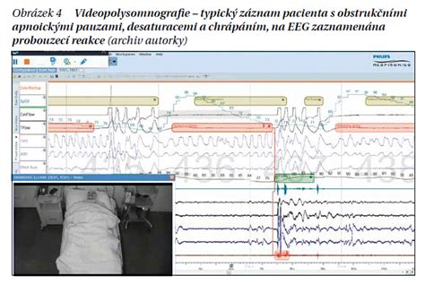 Schéma porovnávající centrální a obstrukční spánkovou apnoe u dětí.