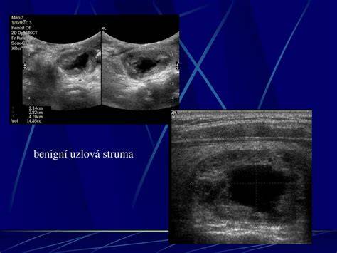 Ultrazvuk štítné žlázy v diagnostice
