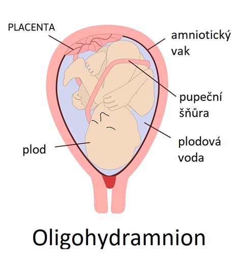 Infografika: Funkce plodové vody, mechanismy oligohydramnion a AFI indikátory