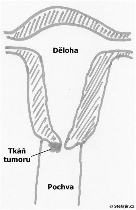 schéma děložního čípku a jeho zrání