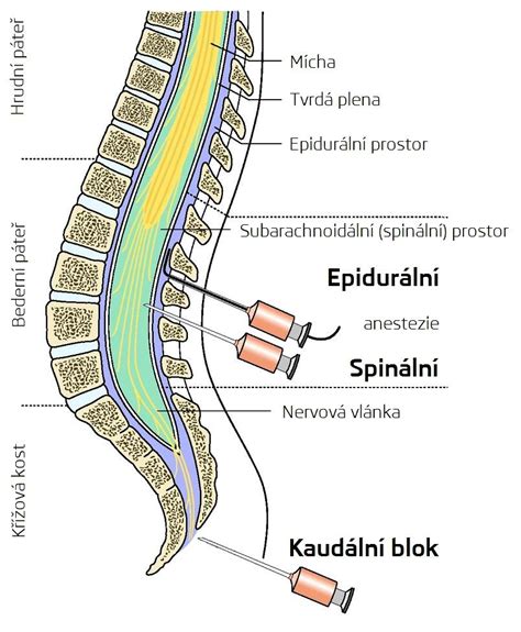 anatomický nákres podání epidurální anestezie
