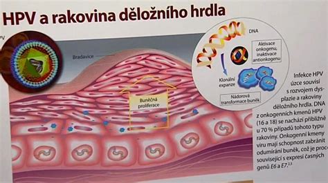 Infografika: Cesta od prekancerózy k invazivnímu karcinomu děložního čípku