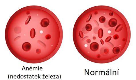 Infografika: Hemové vs. nehemové železo a anemie v těhotenství