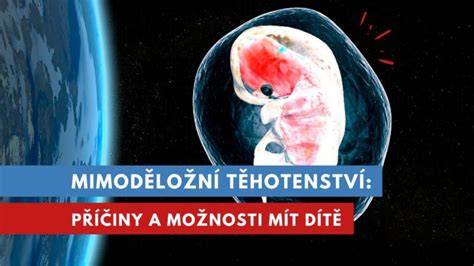 Infografika: Místo jádra těhotenství při mimoděložním