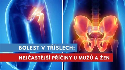 Ilustrace anatomické stavby třísla u mužů a žen s vyznačením místa vzniku tříselné a stehenní kýly.