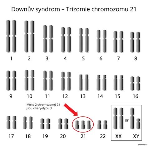 Infografika: Trizomie 13 - cestou od chromozomální poruchy k diagnostice