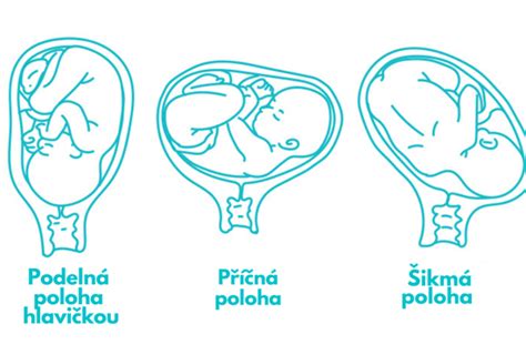 Schéma ukazující správnou polohu plodu v děloze před porodem.