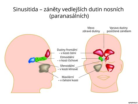infografika znázorňující anatomii nosních dutin a vedlejších nosních dutin