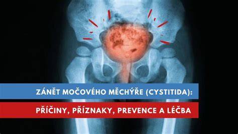 Infografika: Průběh diagnostiky a léčby poranění močového měchýře