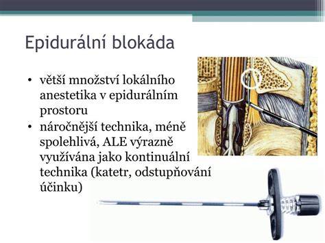 Schéma epidurálního vpichu a šíření anestetika