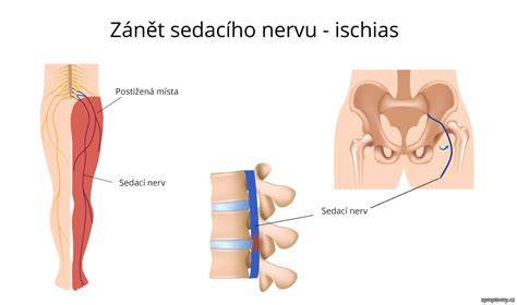 Infografika: anatomie sedacího nervu a hlavní body pro ischias
