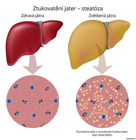 Mapa rizikových faktorů pro onemocnění jater: alkohol, obezita, virové hepatitidy, genetika