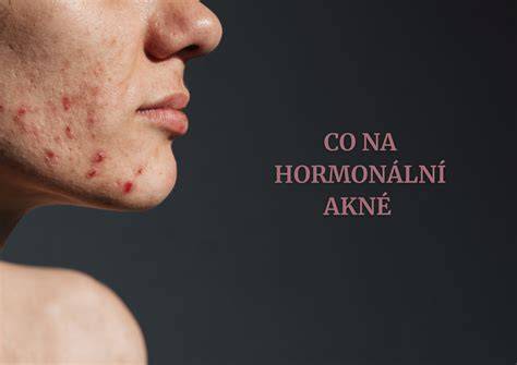 Obrázek znázorňující hormonální akné na dolní části obličeje a typické lokalizace