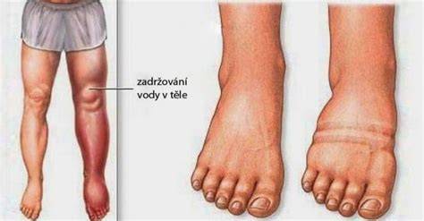 ilustrace zadržování vody v těle v těhotenství - otoky nohou a funkce vody