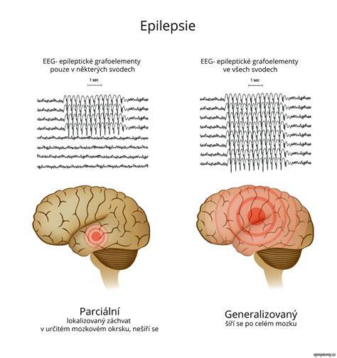 Infografika: typy epilepsie a jejich projevy