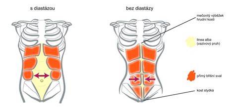 Infografika: anatomie pupečního pahýlu, diastáza a kýla