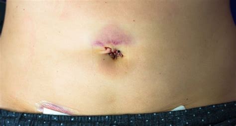 Přehled: Možné komplikace po interrupci a jejich prevence
