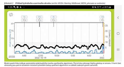 Grafický přehled hybridní uzavřené smyčky a CGM v těhotenství