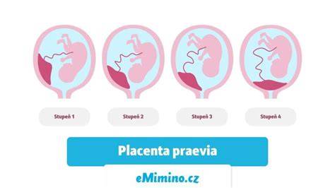 Infografika: Umístění placenty v děloze a možnosti poloh