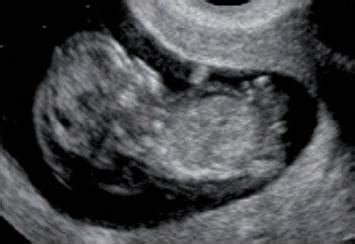 ultrazvukový nález plodu ve třináctém gestačním týdnu s abnormálním NT a hydrops