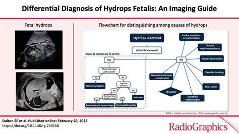 Infografika: mechanismus hydrops fetalis a role krevních transfuzí