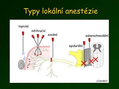 Infografika: Trvání a fáze císařského řezu, typy anestezie, rychlá rehabilitace