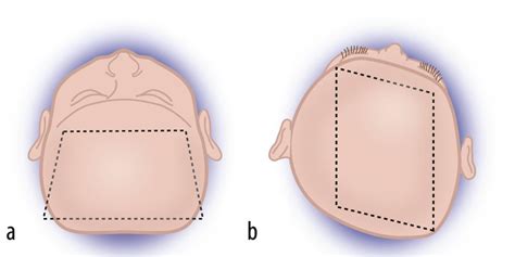 Ilustrace zobrazující rozdíl mezi normálním tvarem hlavy a deformacemi jako plagiocefalie a brachycefalie.