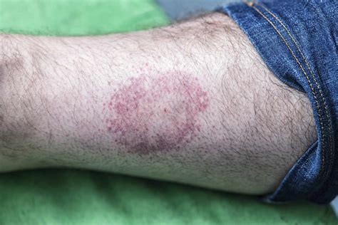 Ilustrace erythema migrans na kůži