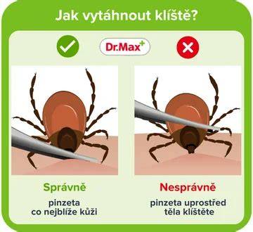 Ilustrace správného držení pinzety při vytažení klíštěte