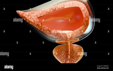Schéma anatomie vejcovodů a místa zákroku při salpingektomii
