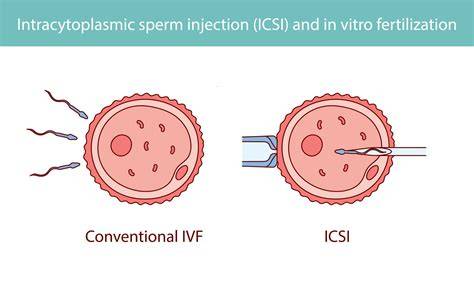 Infografika: Přehled procesu IVF a ICSI