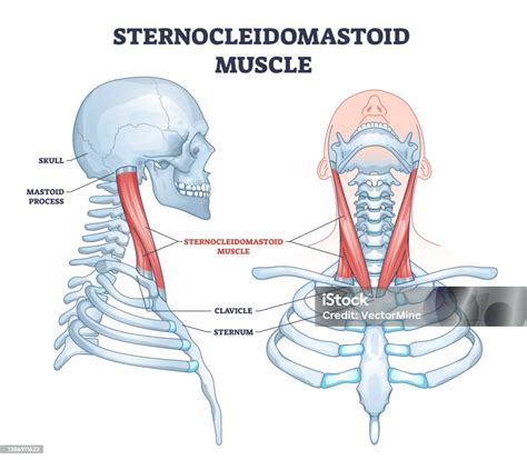 Schéma svalů krku a hlavy pro ilustraci torticollis